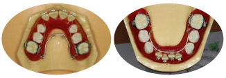 混合歯列期の拡大装置