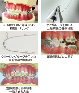 第2巻　２×４による前歯部反対咬合の改善方法