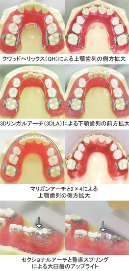 第4巻　固定式装置による拡大と大臼歯のアップライト