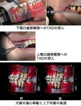 第3巻　TADsによる抜歯矯正の迅速化