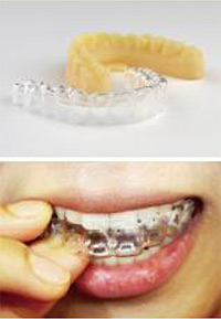 シースルーアライナー